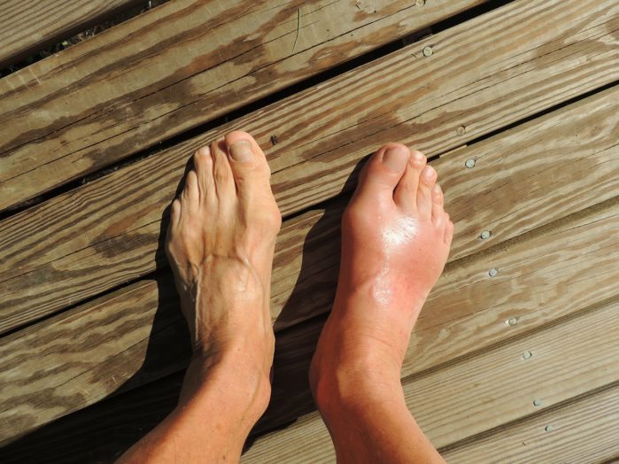 a picture of a swollen foot